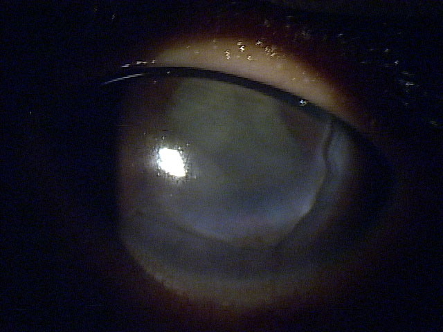 This 13-year-old boy was hit in the eye with his pencil in school, leaving a laceration from 2 o’clock to 9 o’clock. It was pressure patched and seen by cornea specialist, who glued the cornea until the patient could get into the surgical suite, where the surgeon placed 20 sutures to close up the wound.