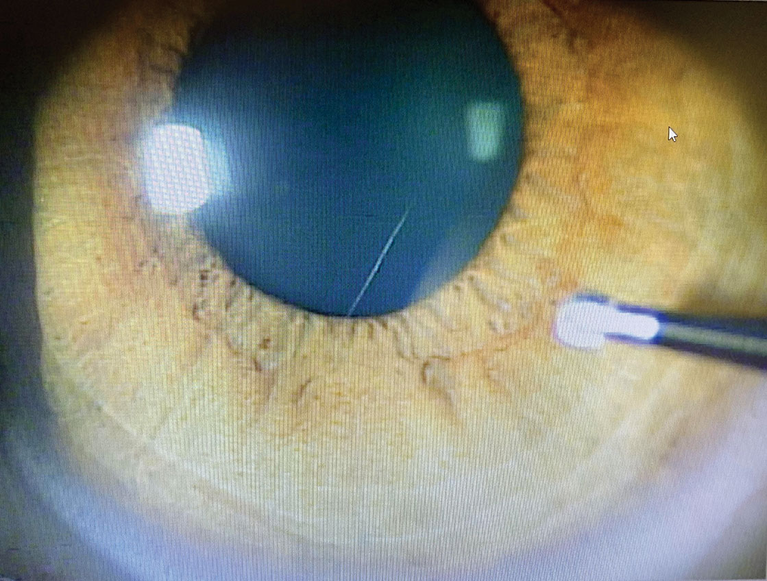 When removing the rust ring from the cornea with the Alger brush, make sure to approach tangentially. This allows for better control of the instrument and pressure applied to the cornea.