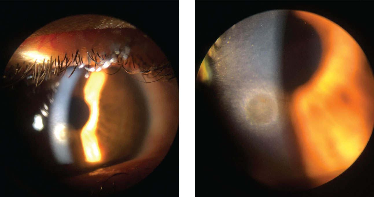 This patient is being seen at follow-up after a metallic foreign body was removed. While the epithelium has fully healed, there is a remaining rust ring.