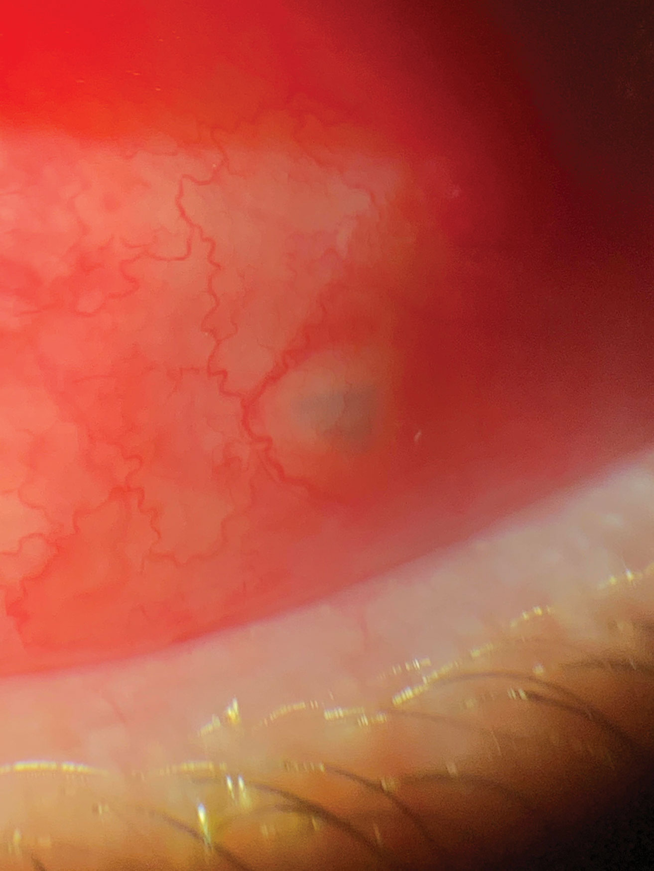 This patient presented to the office within eight hours of being hit in the eye with a tree branch. A piece of bark had lodged itself under the conjunctiva. The foreign body was removed with forceps through the entry point with no sutures needed.