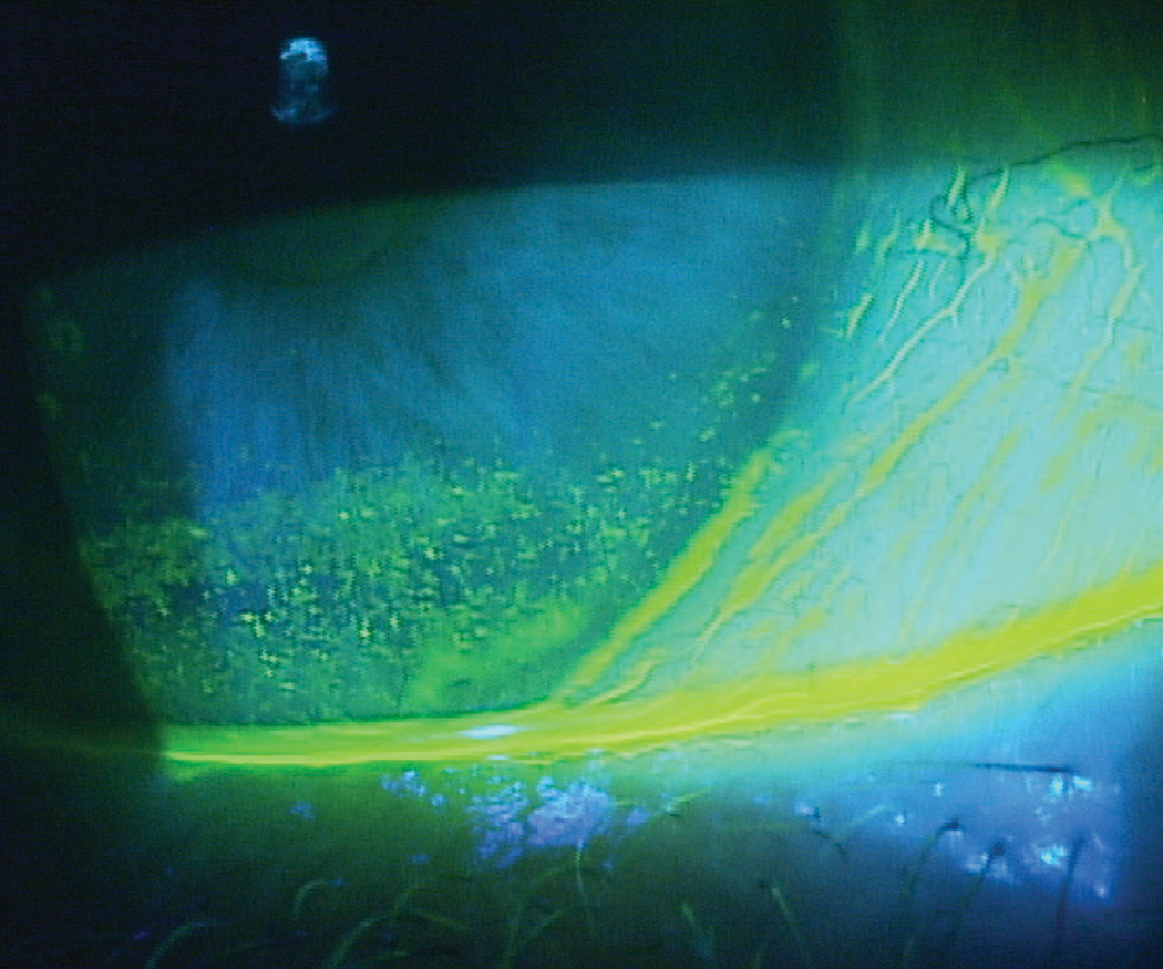 Patients with inferior corneal staining secondary to lagophthalmos, as seen here, may struggle with contact lens wear if it’s not addressed first. 