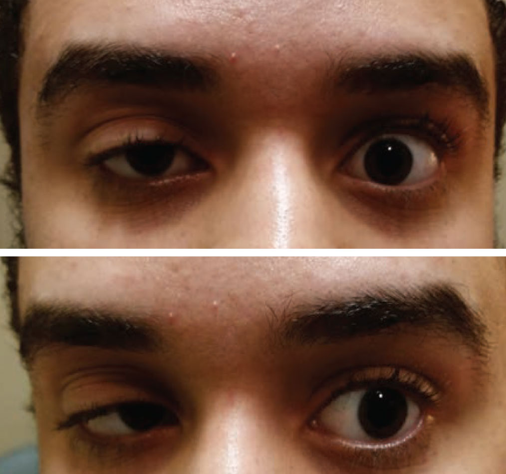 Acquired ptosis in one eye and a motility restriction in the other should be considered myasthenia gravis until proven otherwise. Photo: Paul Ajamian, OD.