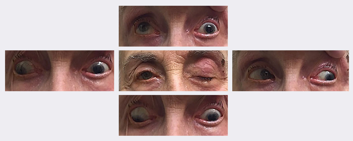 At this patient’s initial visit, she had ptosis with restricted upgaze, downgaze and adduction. She was eventually diagnosed with a complete, pupil-sparing left 3rd nerve palsy secondary to herpes zoster. She resolved in approximately two weeks using an antiviral. Photos: Michael Trottini, OD. 