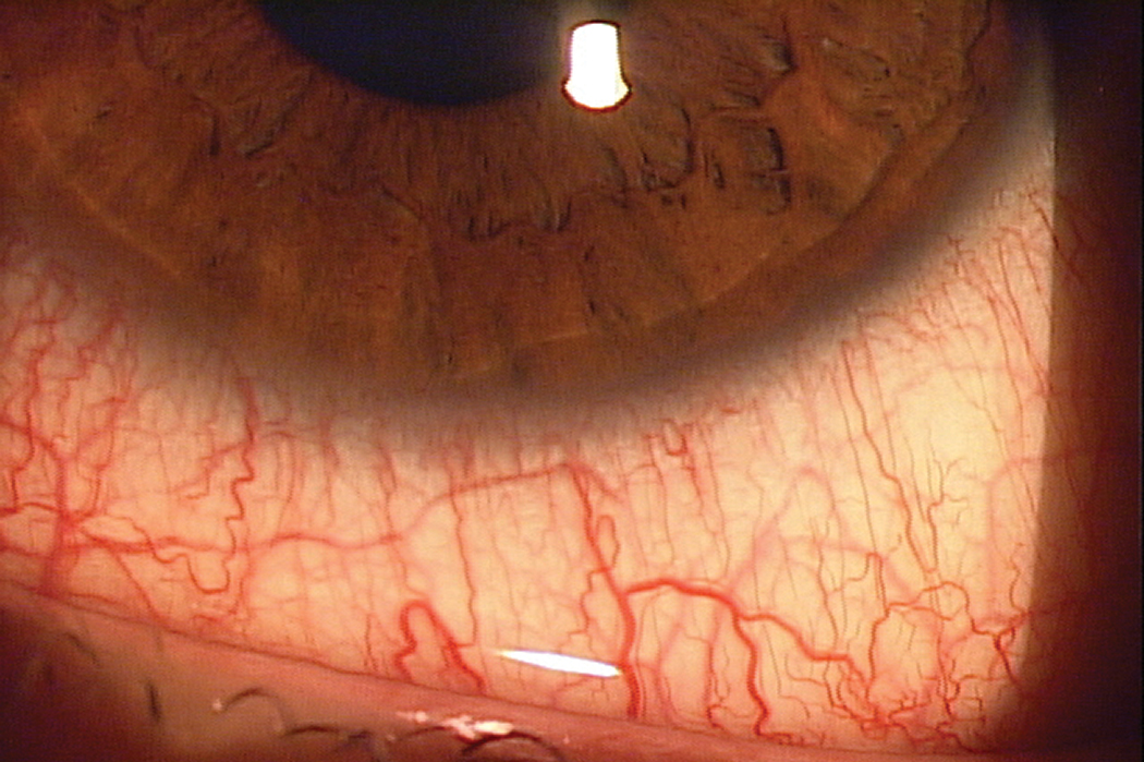 The conjunctiva is among the tissues that are likely to be penetrated by the conronavirus.  No treatment exists yet, but identifying infection early can assist in management.
