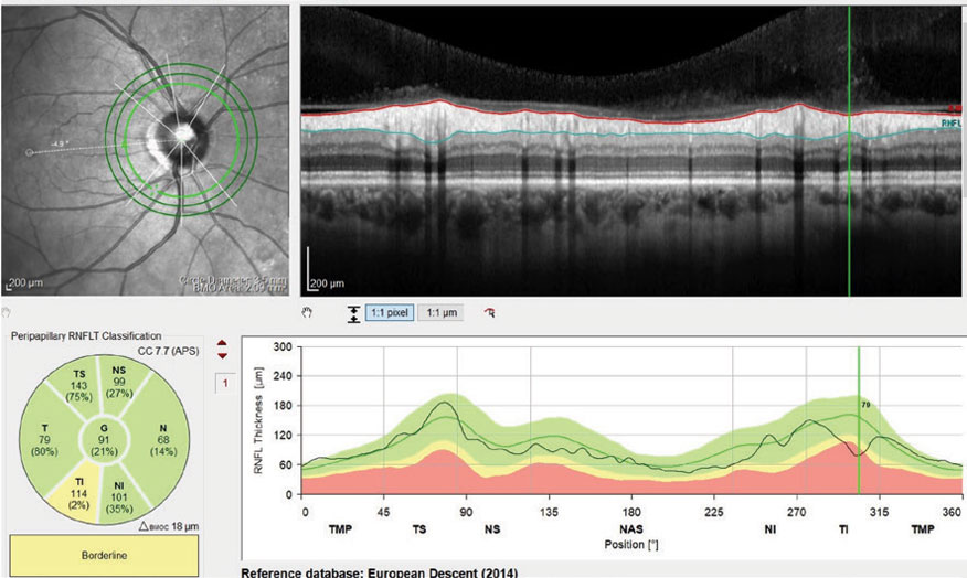 Fig. 2. This scan demonstrates a small area of potentially deceased RNFL thickness in the inferotemporal sector of the patient’s right eye.