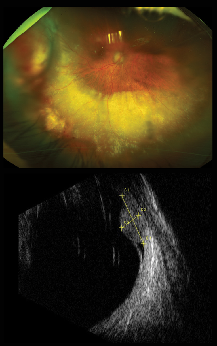 Figs 1 and 2. At top, our patient’s right eye, seen in widefield image, has an elevated lesion. Below, the B-scan through the lesion below also shows its thickness and the overlying retinal detachment.