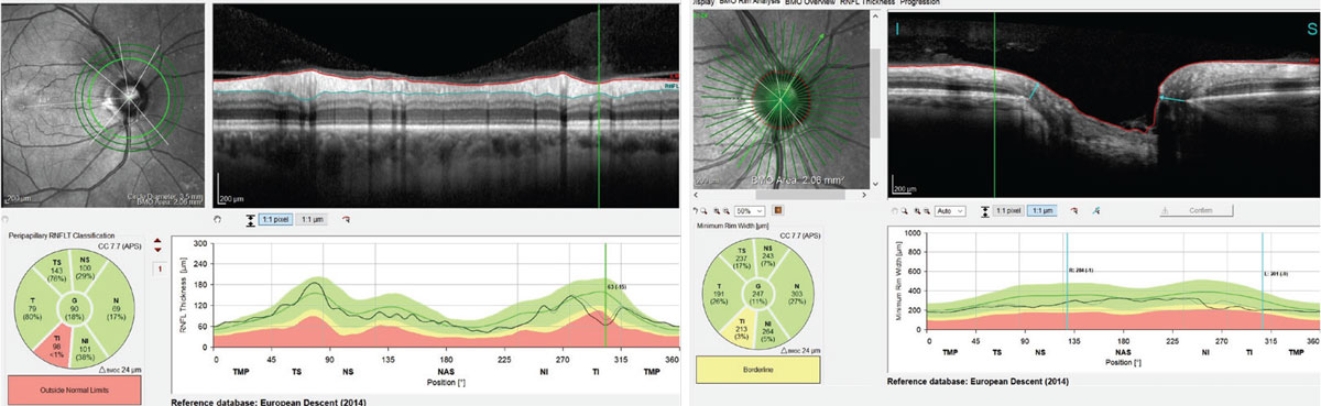 Figs. 3 and 4. Left, this scan demonstrates a loss of 15µm of the patient’s RNFL thickness in the inferotemporally segment. Right, this scan demonstrates a change the inferotemporal neuroretinal rim consistent with the RNFL scans, indicating thinning of the BMO-MRW measurement.