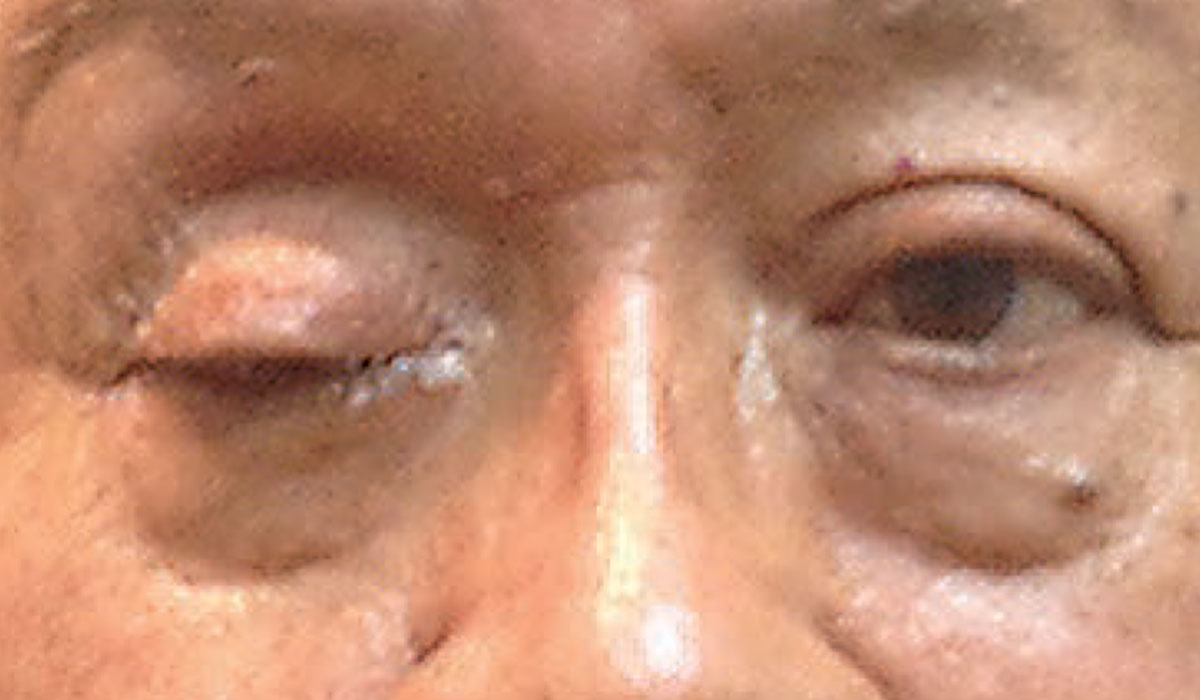 Complete ptosis could indicate the presence of an emergent neurological condition. Photo: Michael Trottini, OD