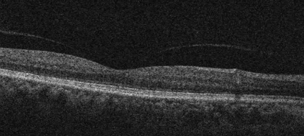 Case 2. Here is a macular OCT of a 64-year-old black female with focal VMA in the right eye. BCVA is 20/20 OD. The patient is asymptomatic for metamorphopsia or scotoma and is being monitored yearly.