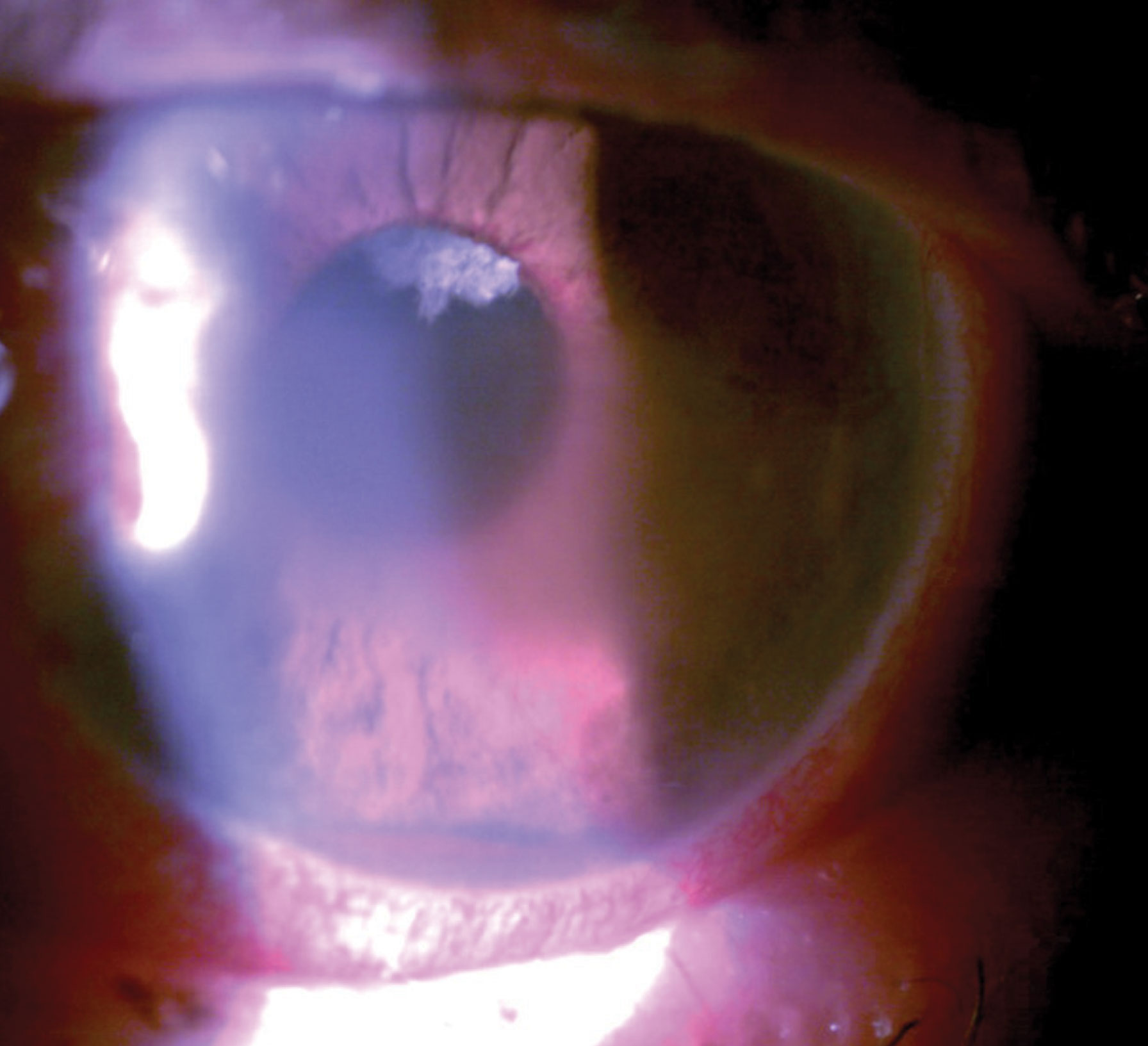 This patient had pain with vision loss and profound pathological findings such as hyphema, microcystic edema and peripupillary iris neovascularization.