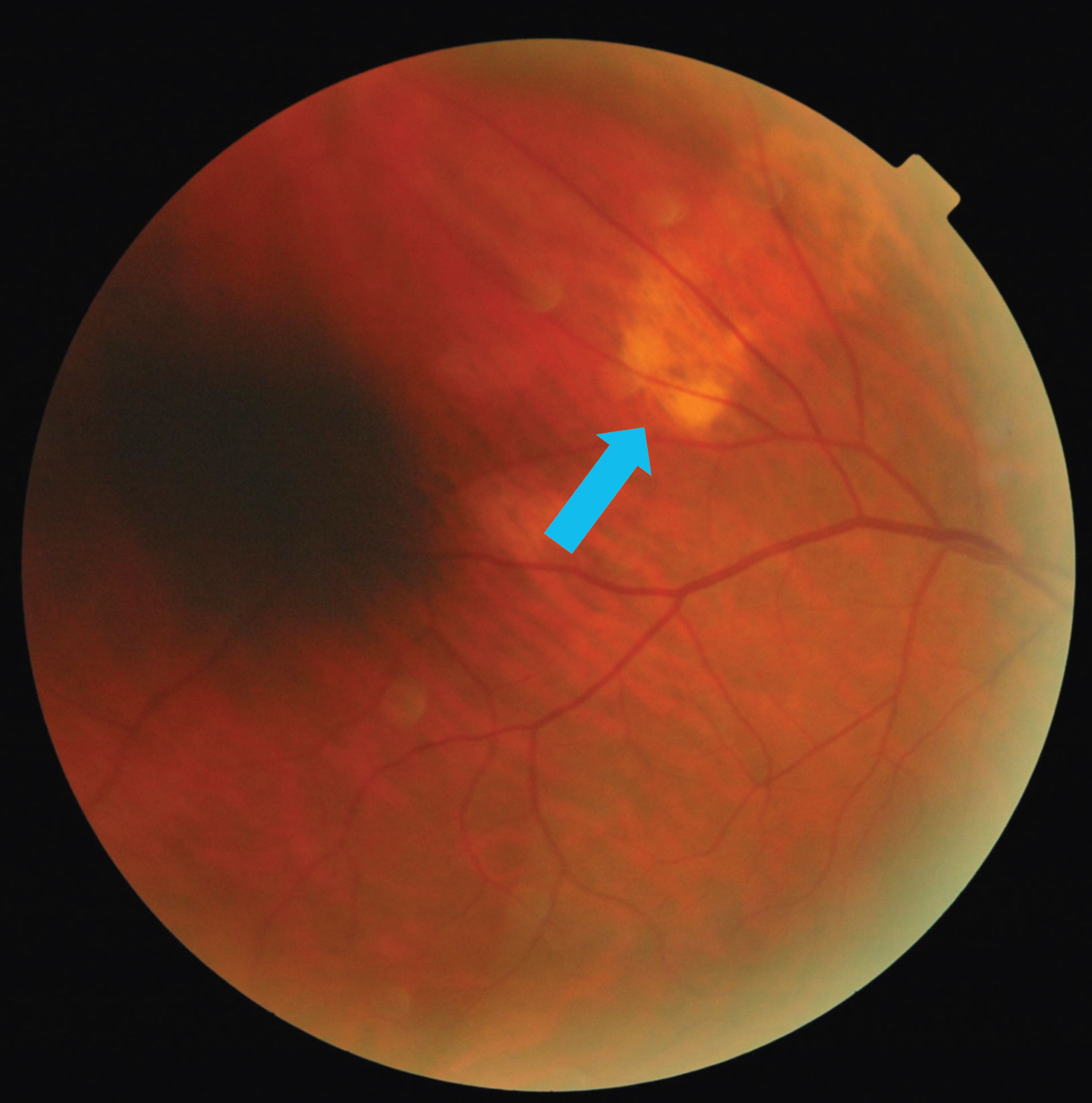 The blue arrow in this fundus photo points to a subretinal lesion in the right eye’s superior temporal quadrant.