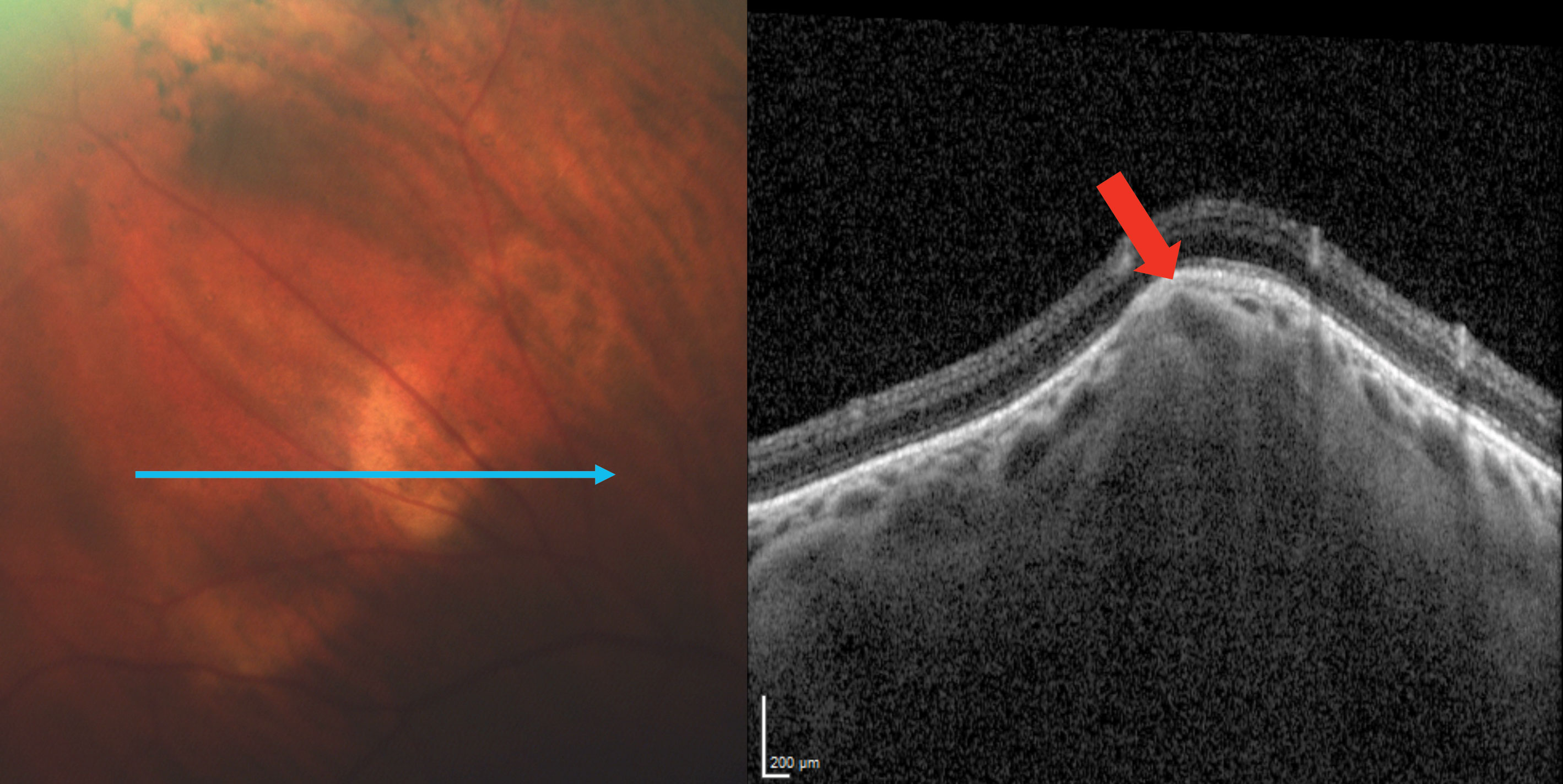 EDI-OCT imaging through the SCC reveals a Type 2 “rolling” lesion. The red arrow points to an area of choroidal thinning above the lesion.