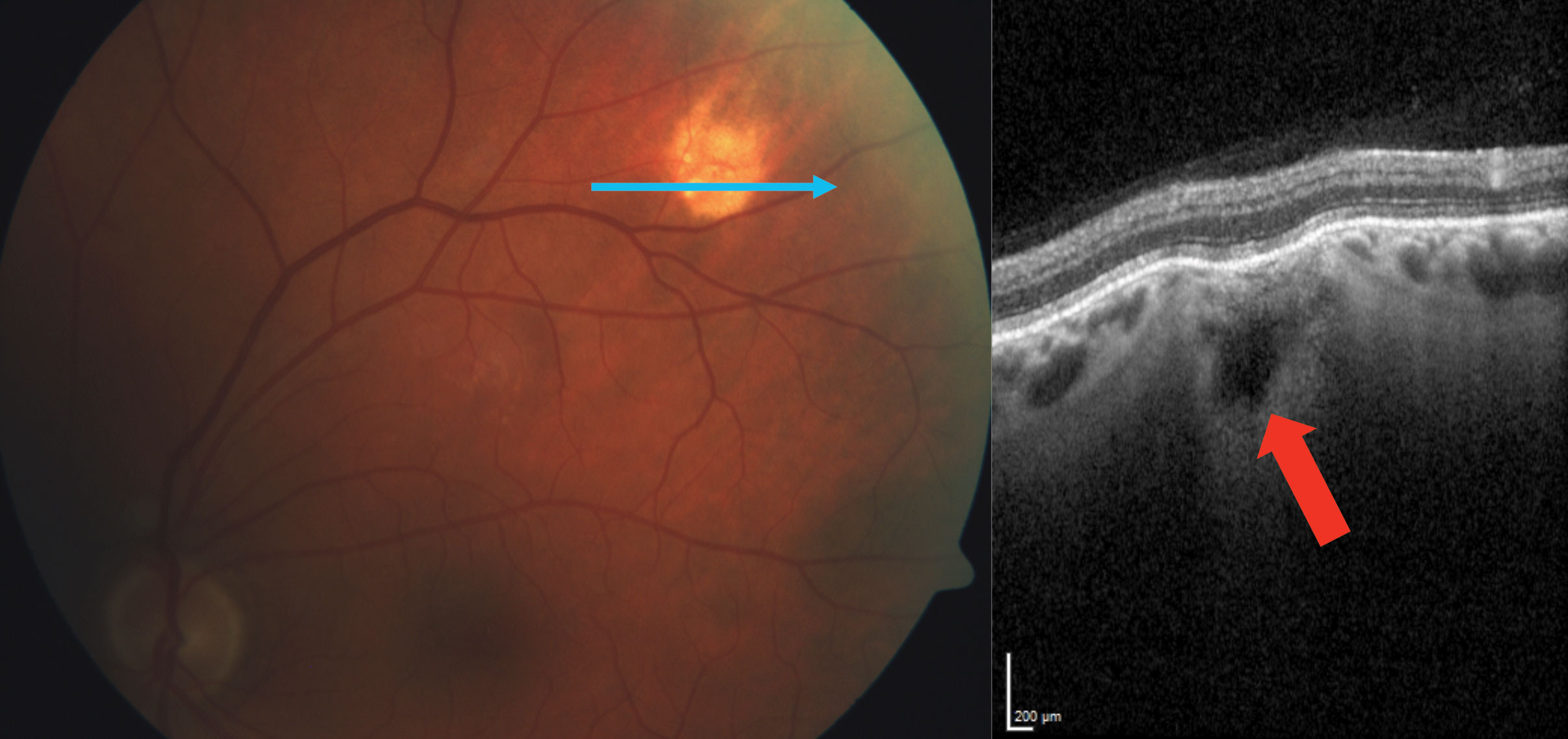Another SCC patient exhibits a Type 3 “rocky-rolling” appearance. The red arrow shows the extensive choroidal thinning above the scleral mass.