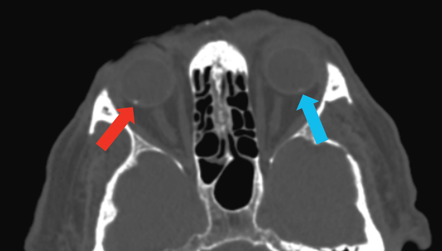 This CT scan demonstrates SCC in the right eye (blue arrow) and a subtle one in the left eye (red arrow), which was not visible on clinical exam.