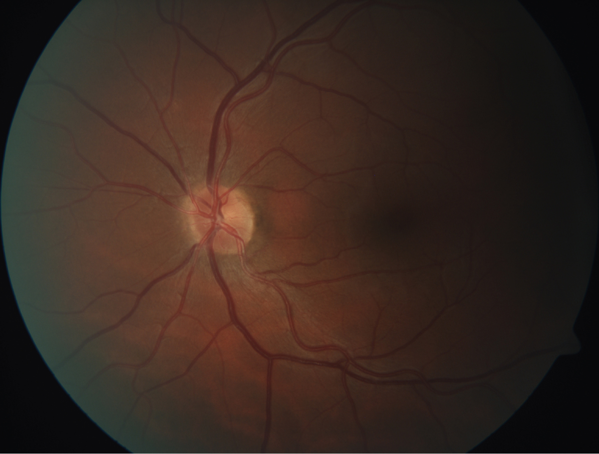 This fundus image shows retinal arteriosclerosis in a 45-year-old patient with a total cholesterol of 304, triglycerides of 1,290 and LDL of 129.