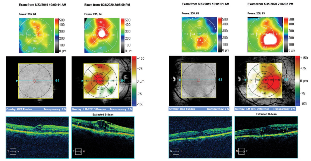 Here, the same 55-year old patient’s macular cube change analysis of right and left eyes demonstrate the frank progression of DME over the course of six months.