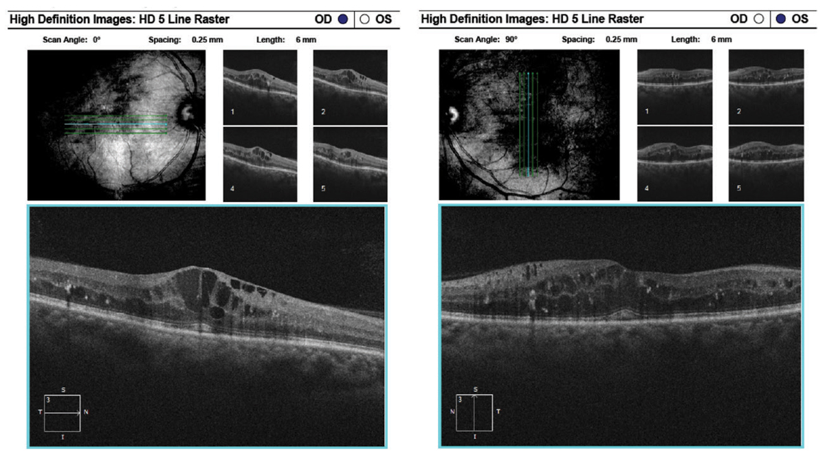 Here, raster images of the previous patient show center-involved macular edema of the right eye and diffuse edema and retinal thickening of the left eye.