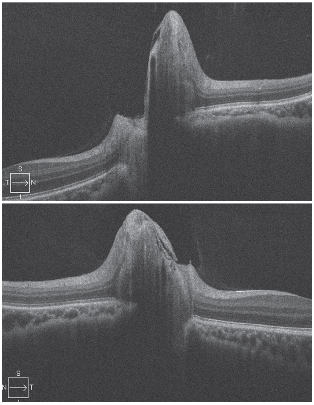 Fig. 2. Bilateral optic disc edema is visible in a patient with IIH, OD on top.