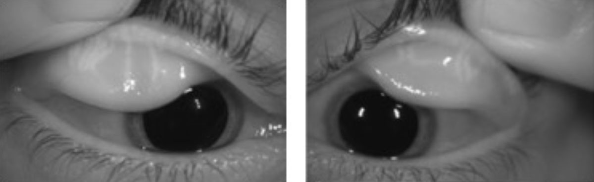 This patient’s meibography reveals signs of severe dry eye in a patient with meibomian gland dysfunction.