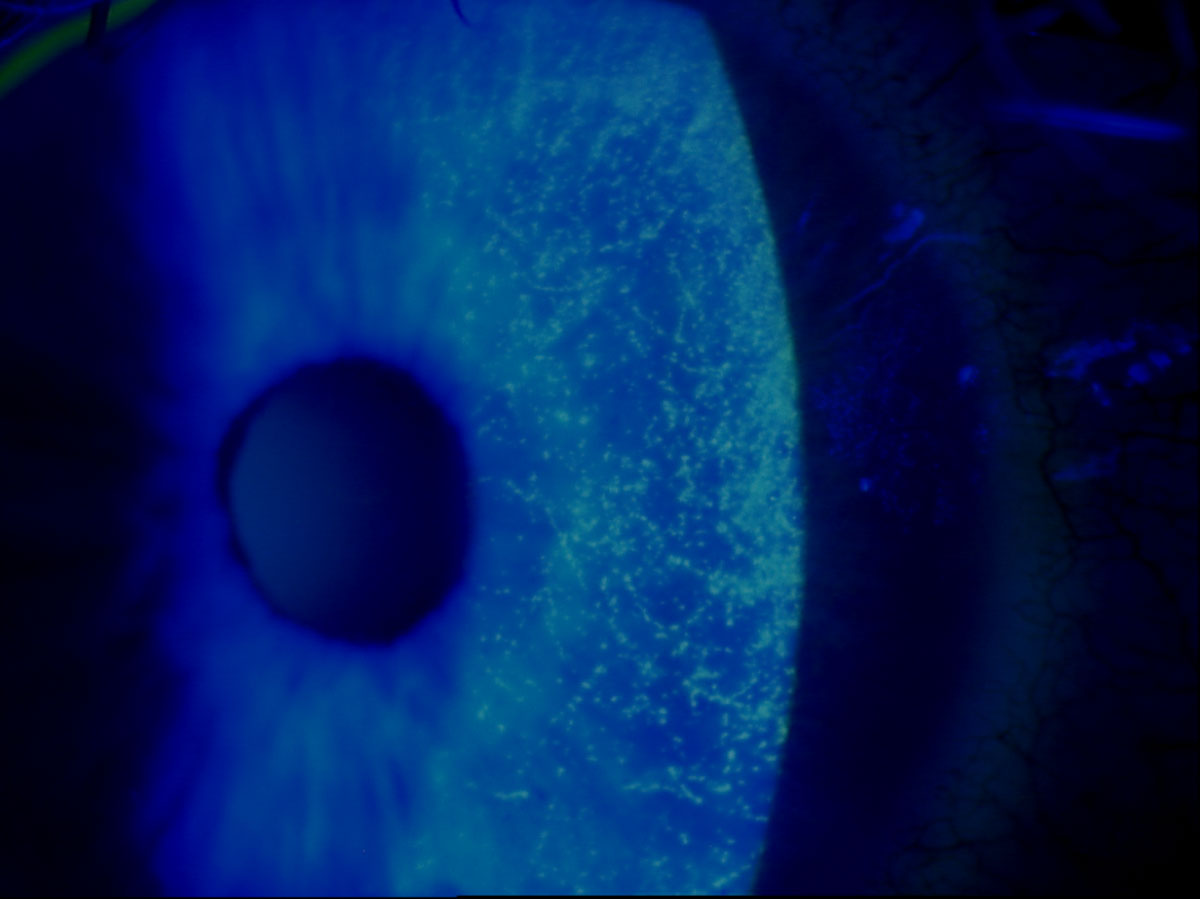 This slit lamp photo demonstrates sodium fluorescein staining of a patient’s eye with punctate keratitis. 