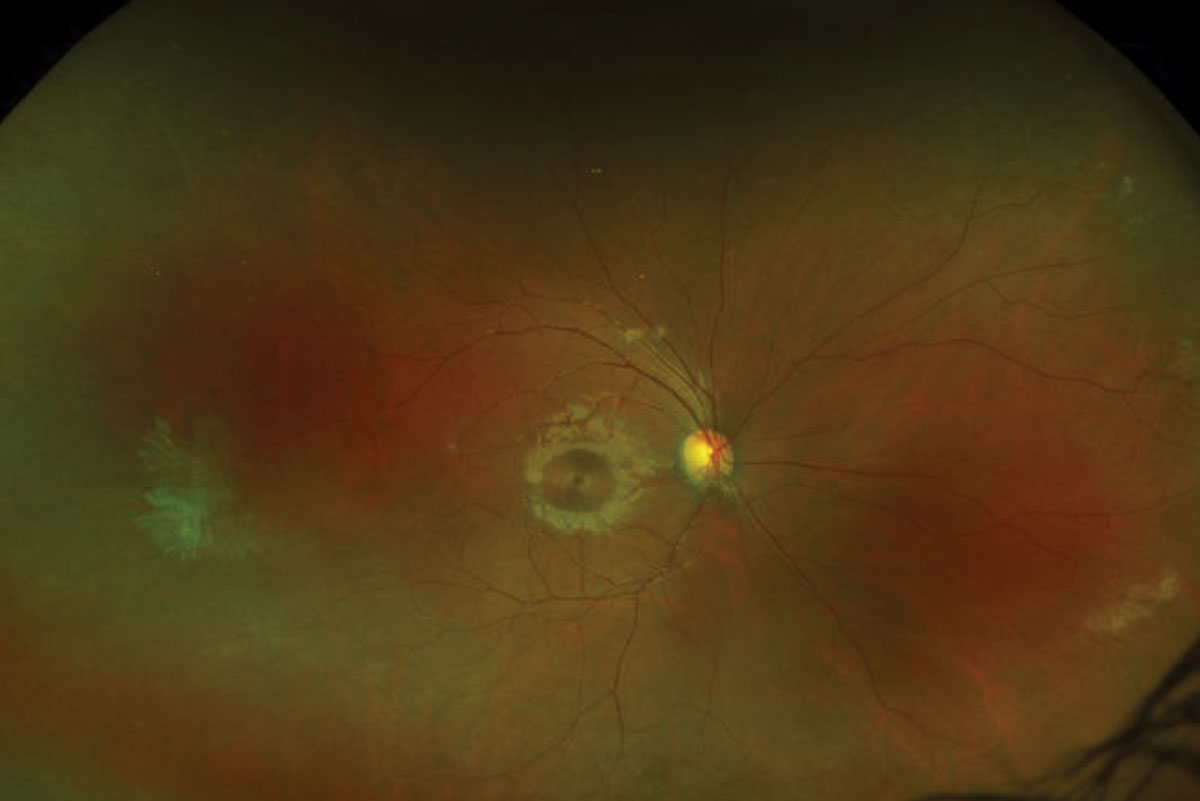 Fig. 1. These ultra-widefield fundus photos show our young patient’s right (at top) and left eyes. What do you notice that can explain his blurry vision? 