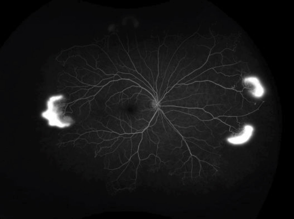Fig. 2. The ultra-widefield FA shows our patient’s right eye in mid phase, at left, and left eye in the early phase.