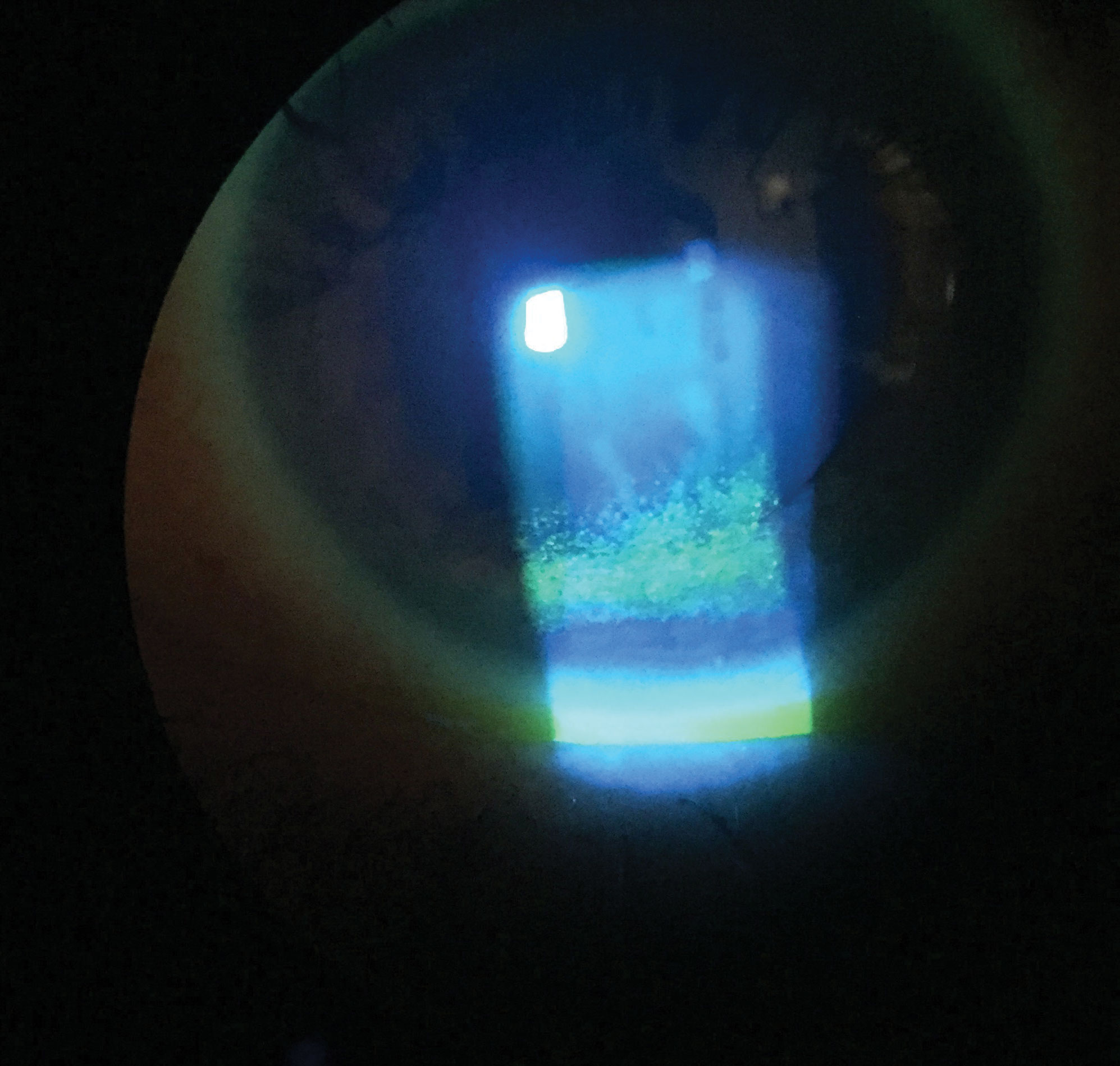 This patient has extensive punctate epithelial keratitis and decreased TBUT.