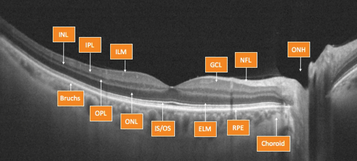 Fig. 2. OCT can help clinicians evaluate the retina, layer by layer.
