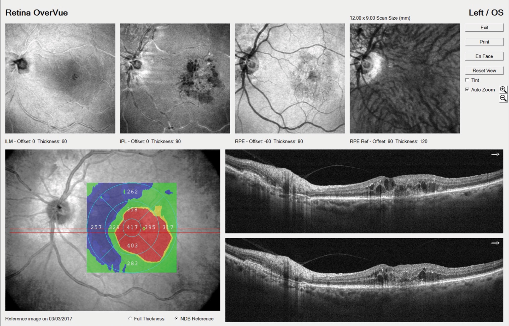 OCT imaging shows the left eye of an 81-year-old CNVM patient with intraretinal fluid. He’ll be treated with intravitreal anti-VEGF injections.