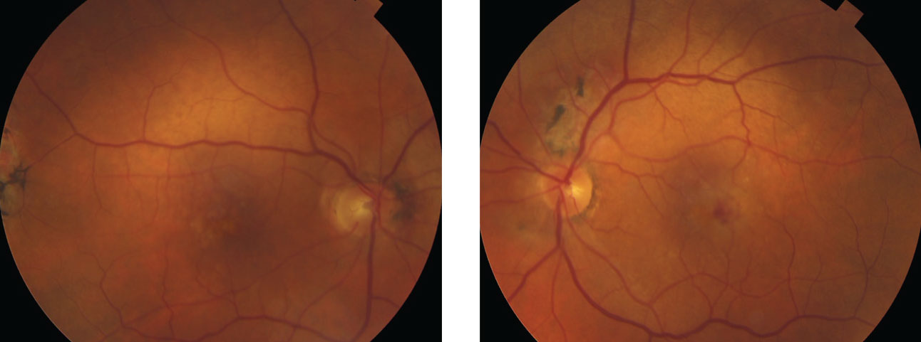 These fundus photos show the same patient from page 50. He had a decreased VA in the left eye. Note the heme still visible in the macula, even after treatment. Anti-VEGF injections helped him maintain best-corrected visual acuities of 20/30 OD, 20/70 OS.