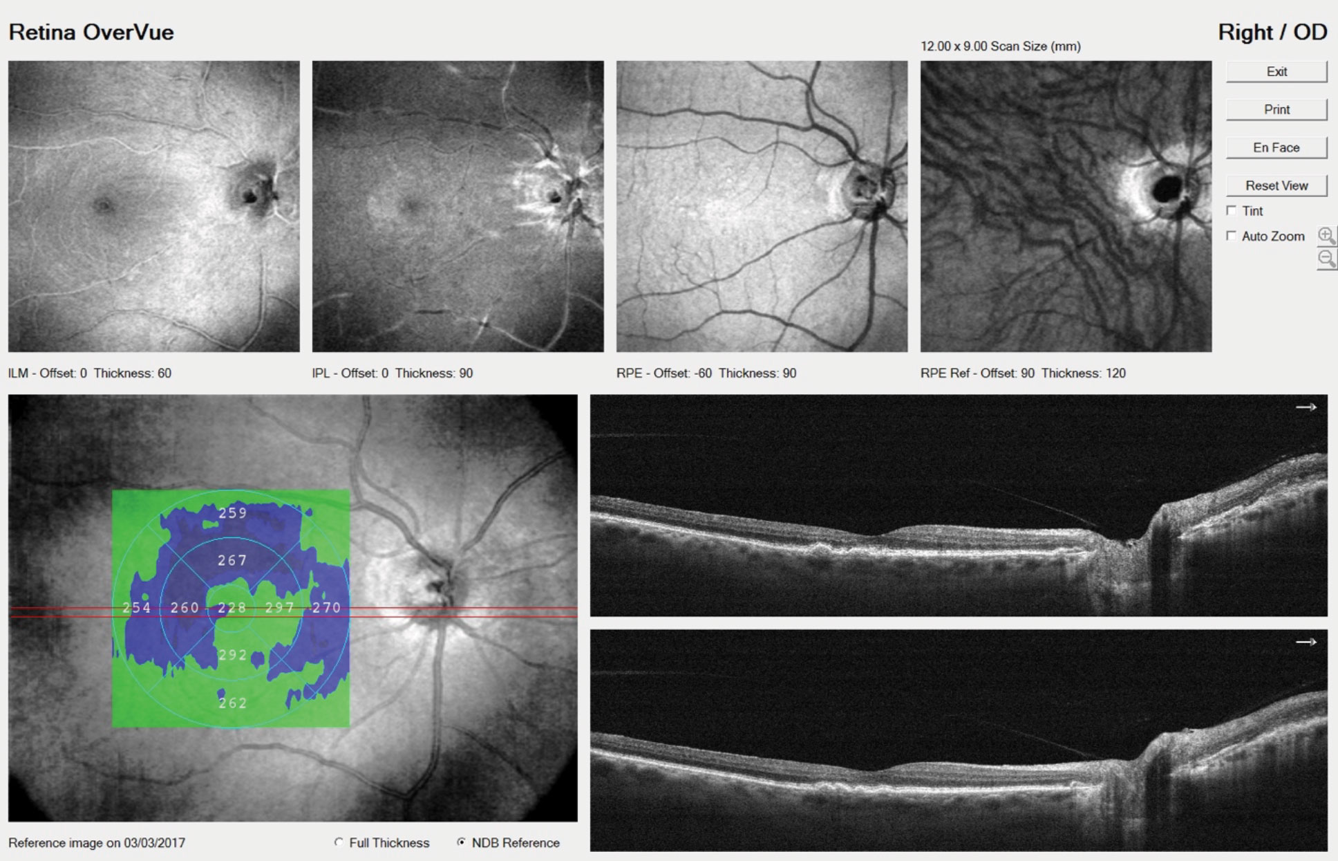 OCT identified a few small drusen in our patient’s right eye. Increasingly, patients who undergo anti-VEGF injections are now being treated bilaterally to reduce the logistical elements of the treatment burden.