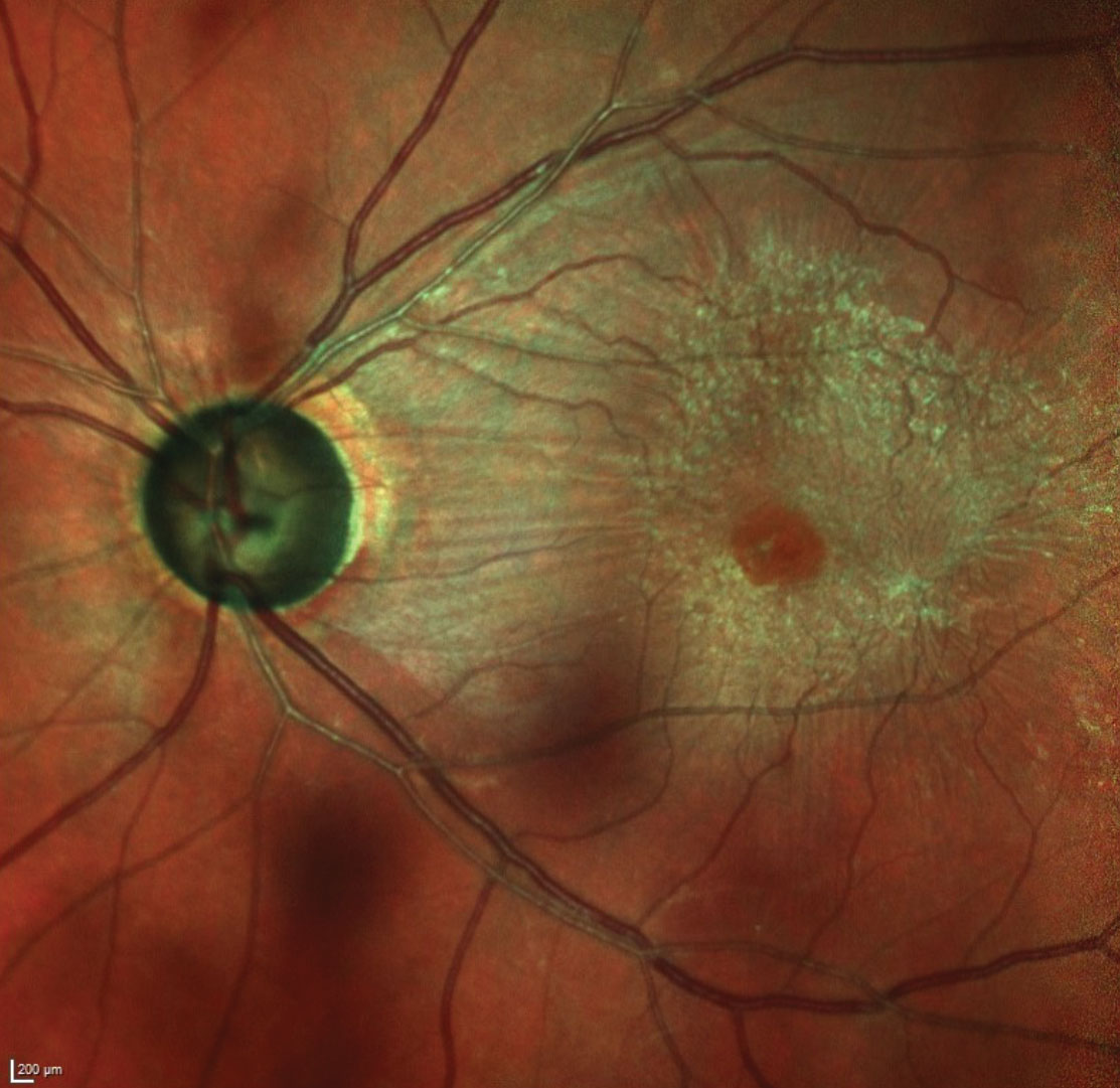 This multicolor image of the left optic nerve and macula shows the patient’s thinned neuroretinal rim as well as the moderate ERM. Also, note the wedge defect inferotemporally. Other wedge defects, if present, were obscured by the ERM.