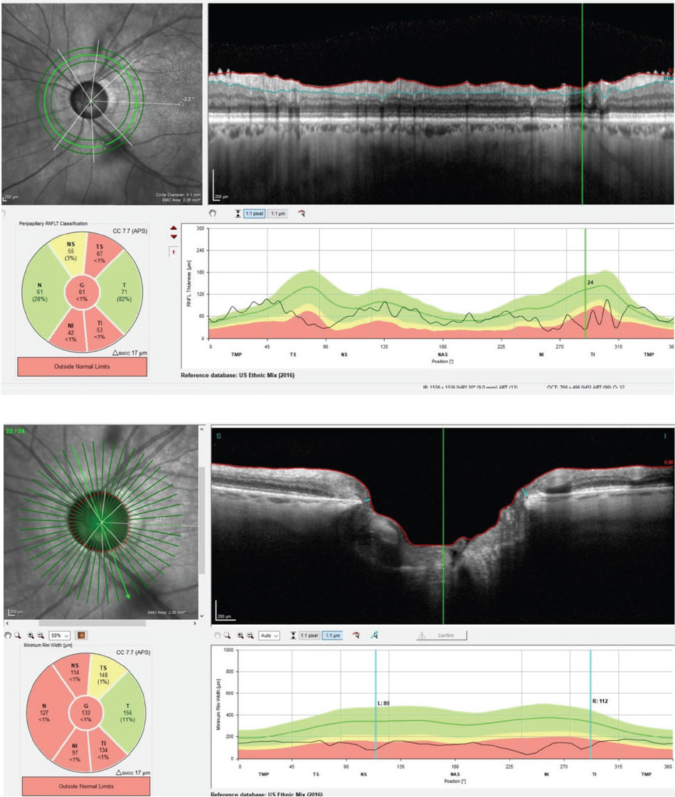 At top, this circumpapillary RNFL scan of the patient’s left eye demonstrates significant loss in the superiotemporal and inferiotemporal sectors of the scan. Below, the same eye’s BMO-MRW scans demonstrates advanced neuroretinal rim loss and thinning. Both scans are consistent with moderately advanced glaucoma.