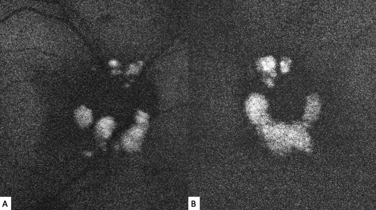 Fig. 2. Fundus autofluorescence of the right (A) and left (B) optic nerves show discrete hyperautofluorescence corresponding with the lesions seen in Figure 1.