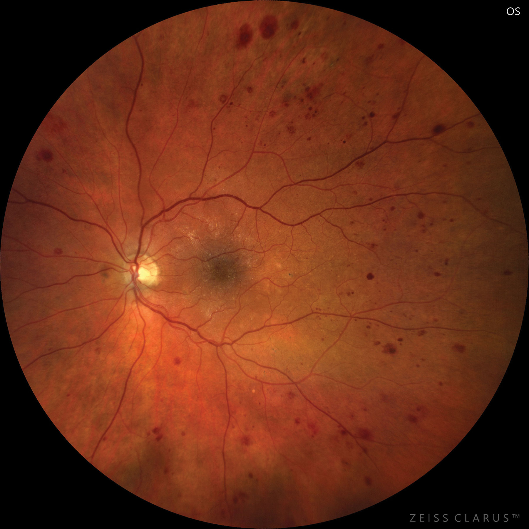 Severe NPDR based on hemorrhages and microaneurysms in four retinal quadrants.