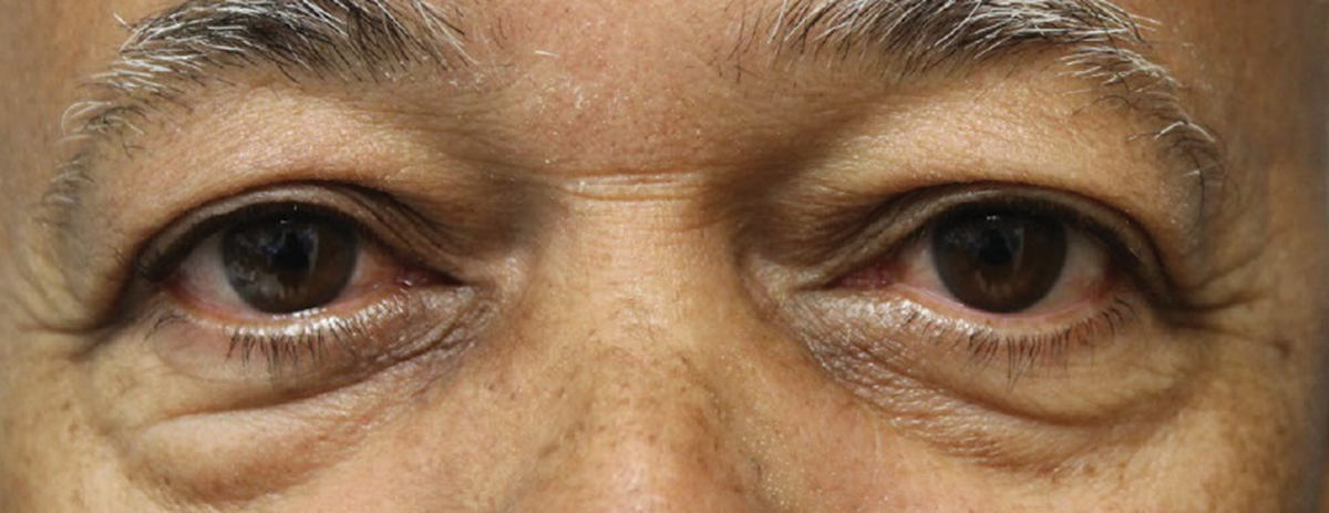 Fig. 2. Visible improvements can be seen in the patient’s eyes after the first Tepezza infusion.