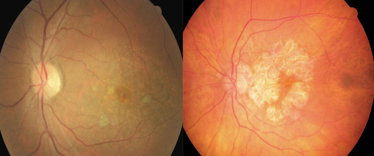 These fundus images show early (left) and advanced geographic atrophy (right). The early patient shows multifocal small extrafoveal regions of GA. In the advanced patient, the lesion has formed an inverted “U” shape almost completely encompassing the fovea, but with apparent foveal sparing.