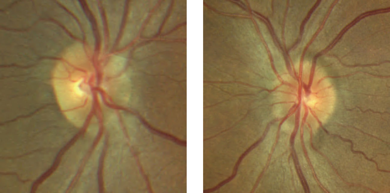 Despite unremarkable entrance testing with no visual complaints, the patient’s optic disc evaluation shows mild elevation with sectoral blurred margins nasally and superiorly OU.