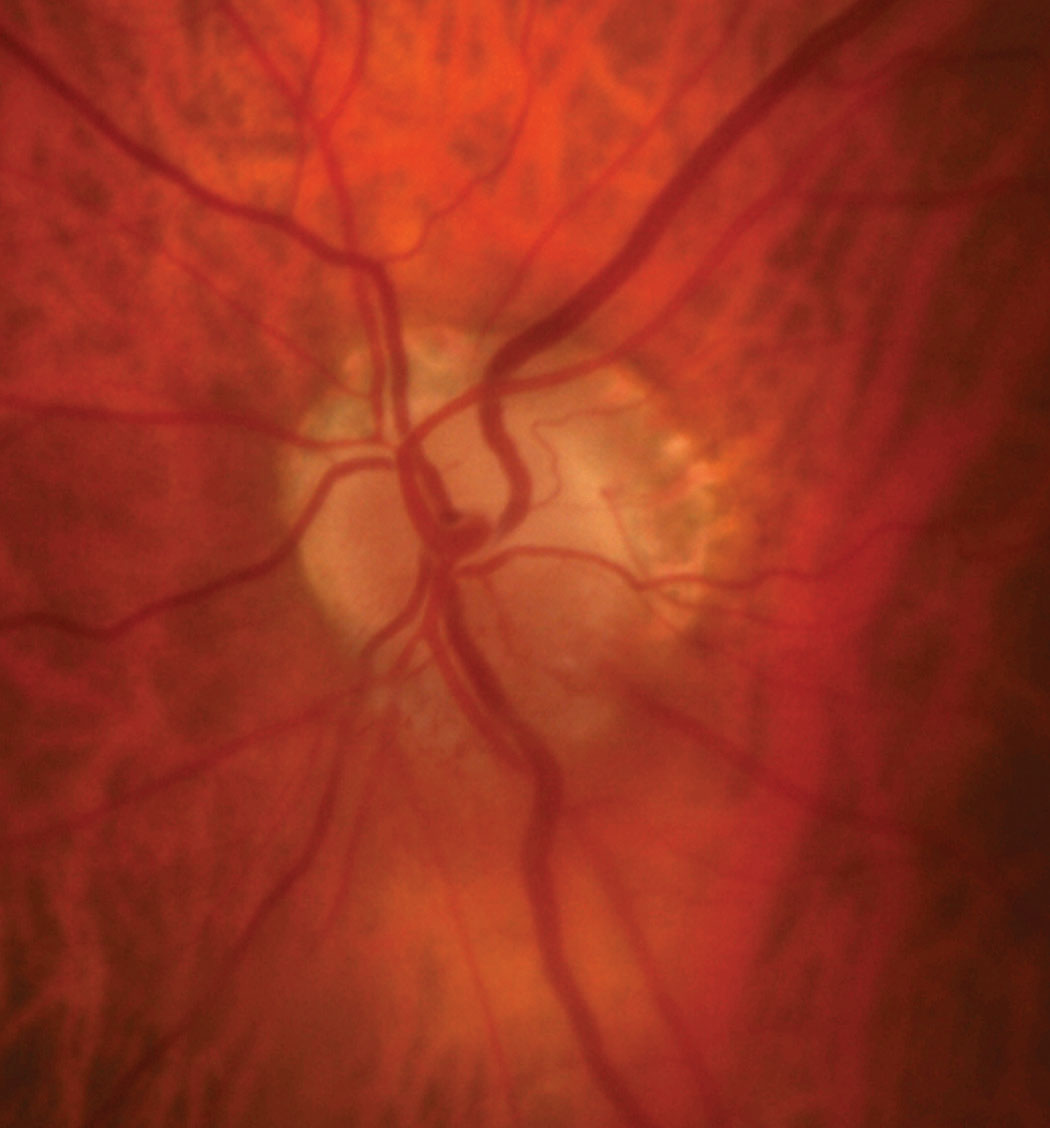 The patient’s optic disc photo demonstrates inferior sectoral elevation with hyperemia. Additionally, there is sectoral pallor of the superior neuroretinal rim OS.