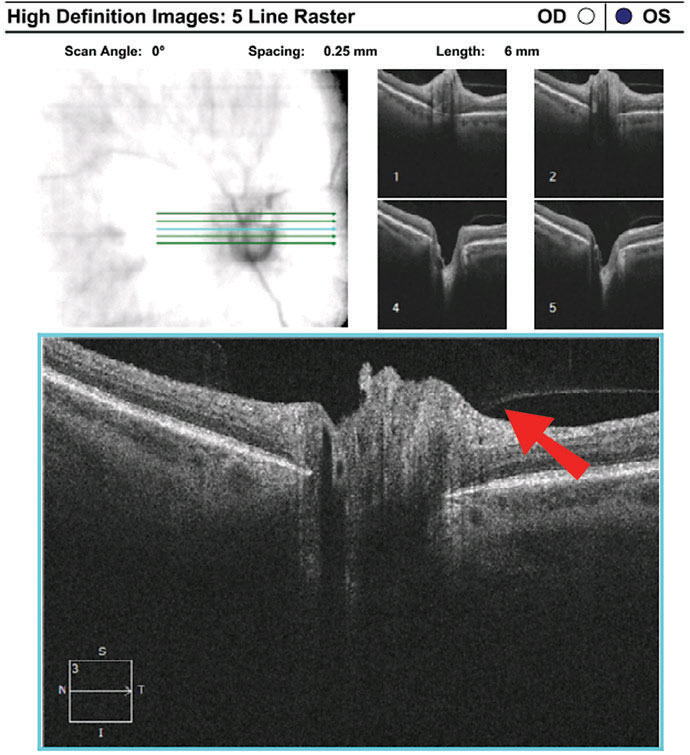 The OCT 5-line raster demonstrates vitreopapillary adhesion.