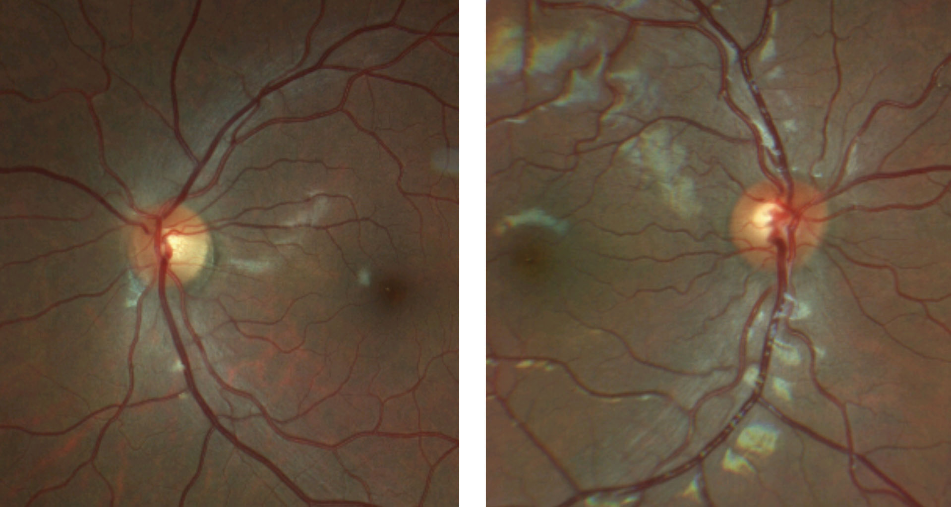 This patient’s fundus photo suggests a pale temporal neuroretinal rim in the left eye.