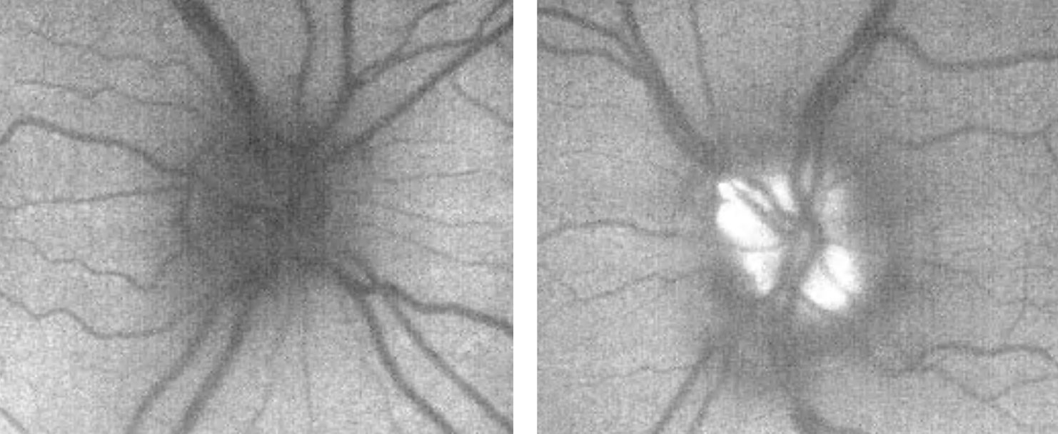 The patient’s fundus autofluorescent photos demonstrate significant autofluorescence of the left optic disc, suggestive of more prominent drusen than what is evident funduscopically.
