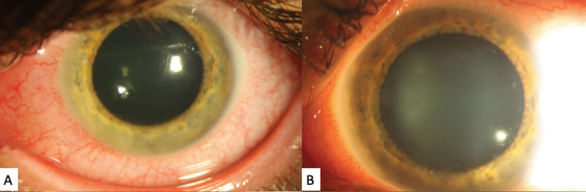 These gross external slit lamp photos of the patient’s left eye shows significant diffuse episcleral injection. A faint posterior corneal opacities can be see, although the detail is poor.