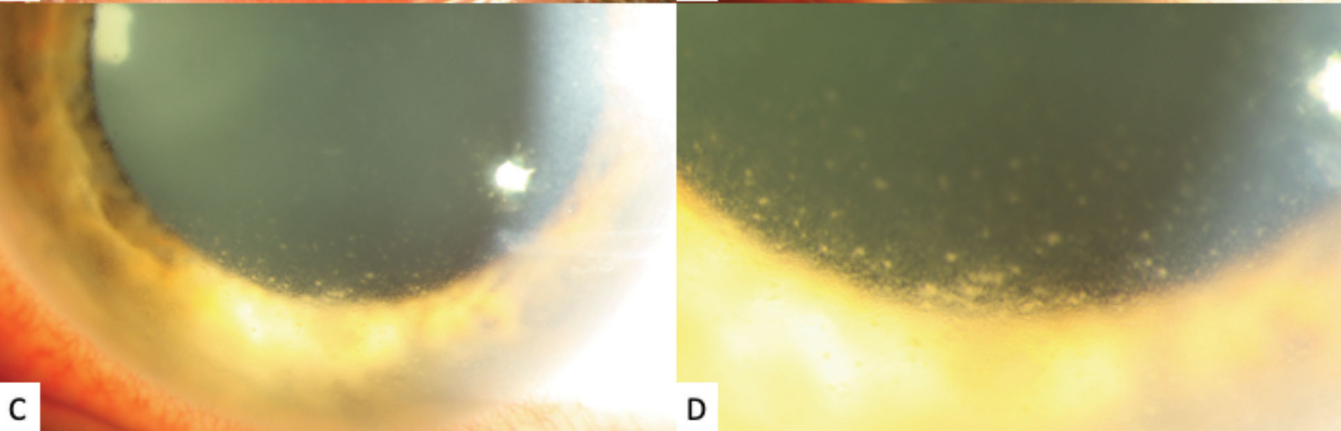 High-magnification slit lamp photographs of the left eye showing inferior stellate keratic precipitates on the lower half of the cornea.