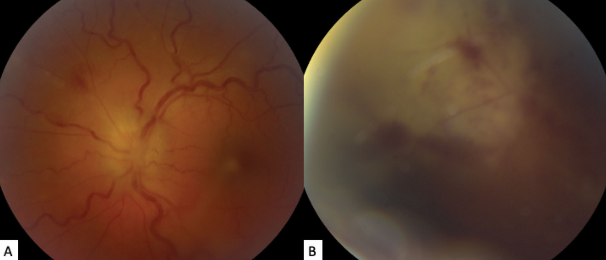 (a) The patient’s fundus photo shows their left eye’s grade 3 optic disc edema, using the modified Frisén scale. Vascular tortuosity, faint retinal whitening and hemorrhaging is also visible superonasally. (b) This photo of the superonasal peripheral fundus shows focal retinal whitening with hemorrhage obscured by vitreous haze.