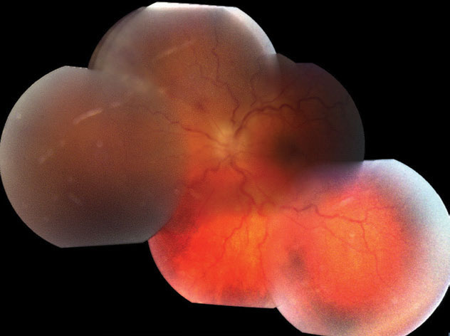 These montage fundus photos portray the patient’s mild vitreous haze, optic disc edema, vascular tortuosity and the posterior aspect of active retinitis superonasally.