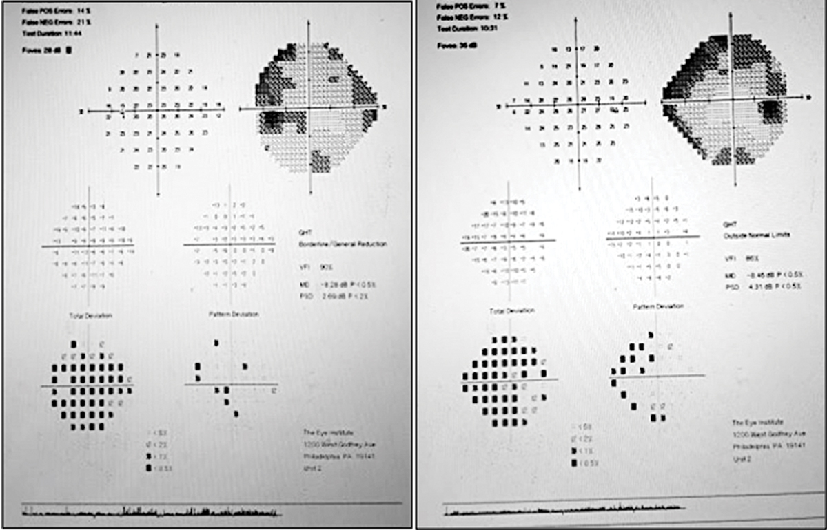 Fig. 4. Humphrey visual field testing of the left eye (left) and right eye (right) shows some points of loss inferior to fixation OD and superior nasal OS.