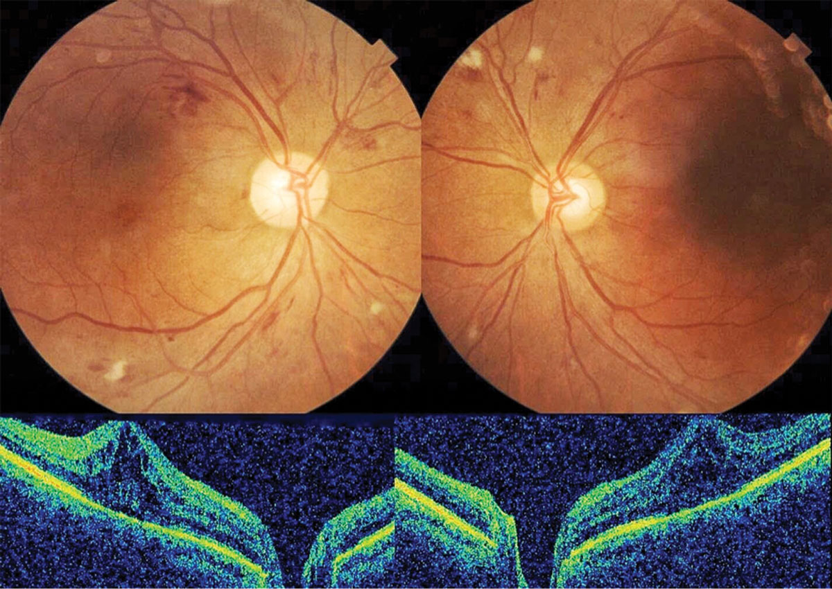 A 66-year-old female had a history of uncontrolled type 2 diabetes and severe nonproliferative retinopathy with diabetic macular edema OU.