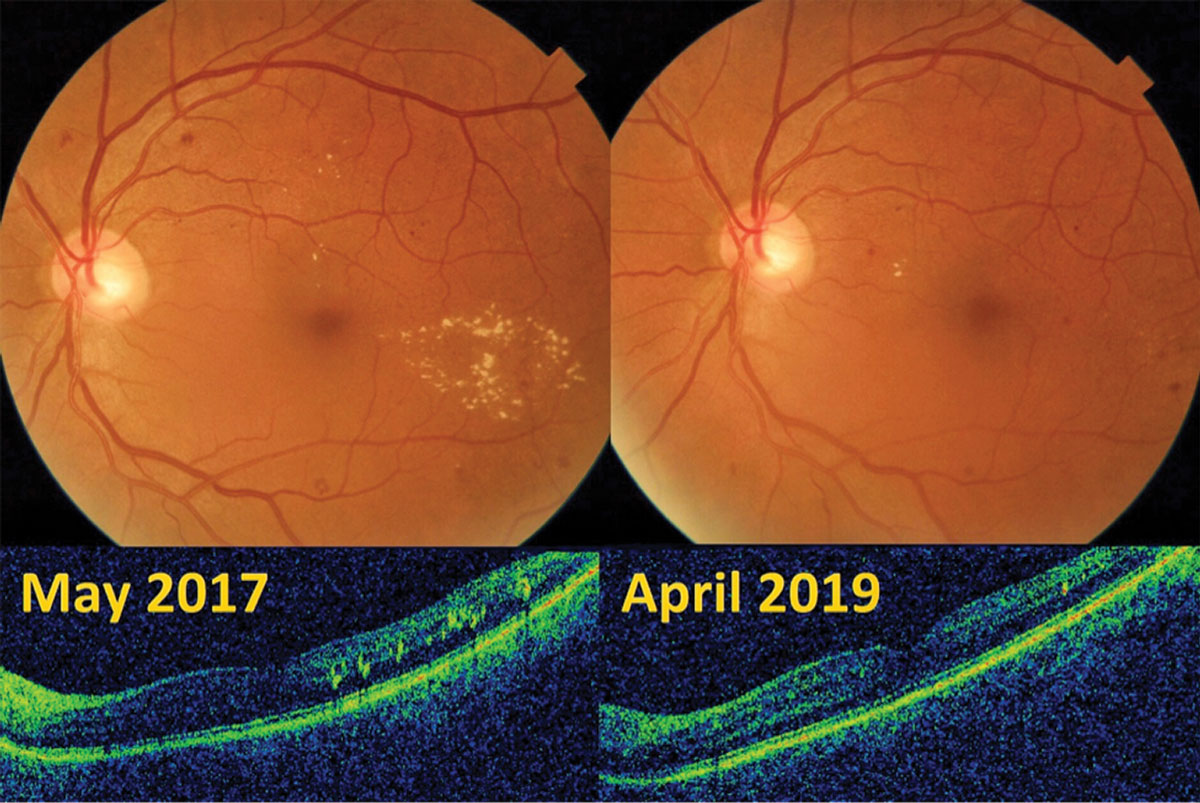 Mild diabetic retinopathy OS with early parafoveal macular edema in a 62-year-old male improved with TRE and carbohydrate restriction.