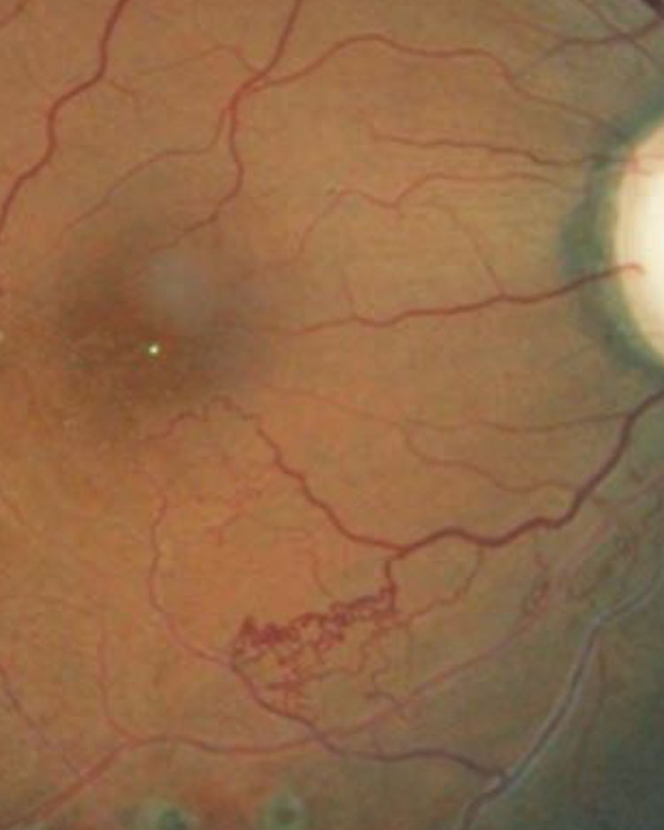 This patient’s retina exhibits collateral vessels bypassing an occluded vessel.